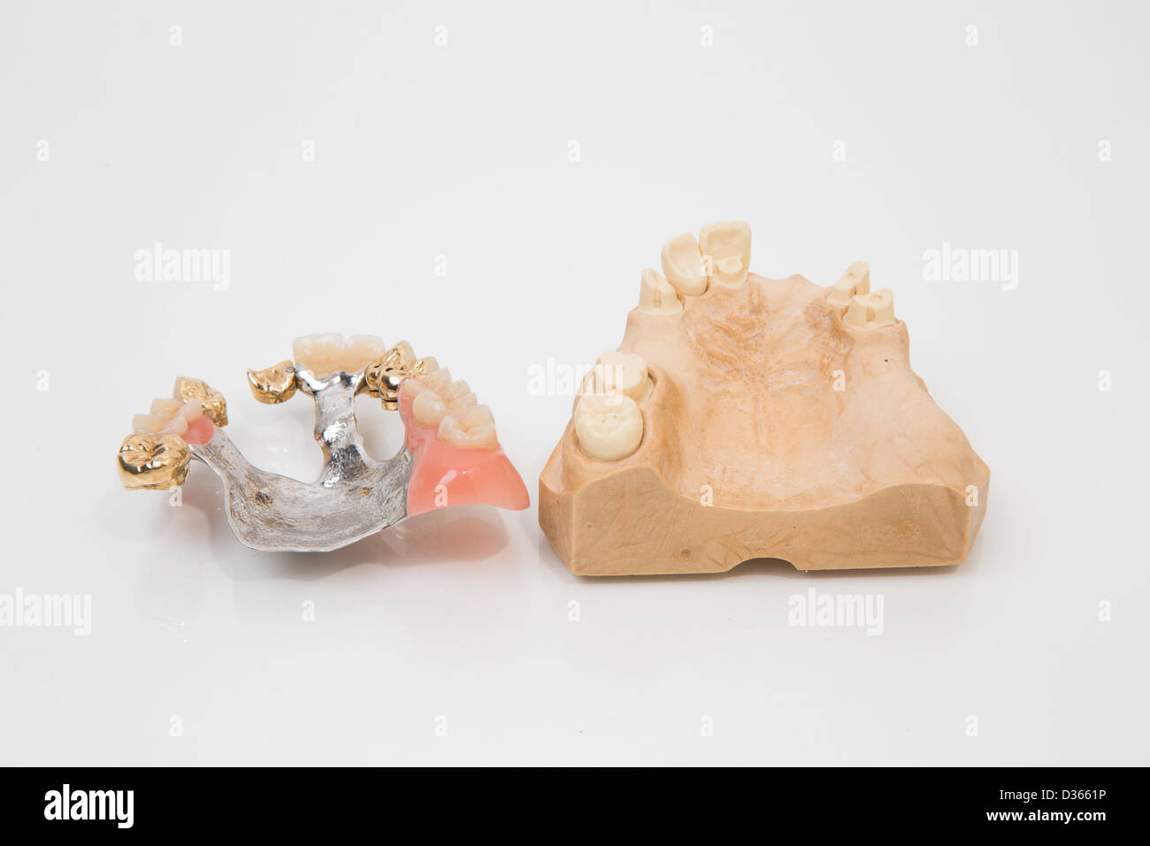 Sophisticated dental prosthesis with gold teeth, bridges and Stock