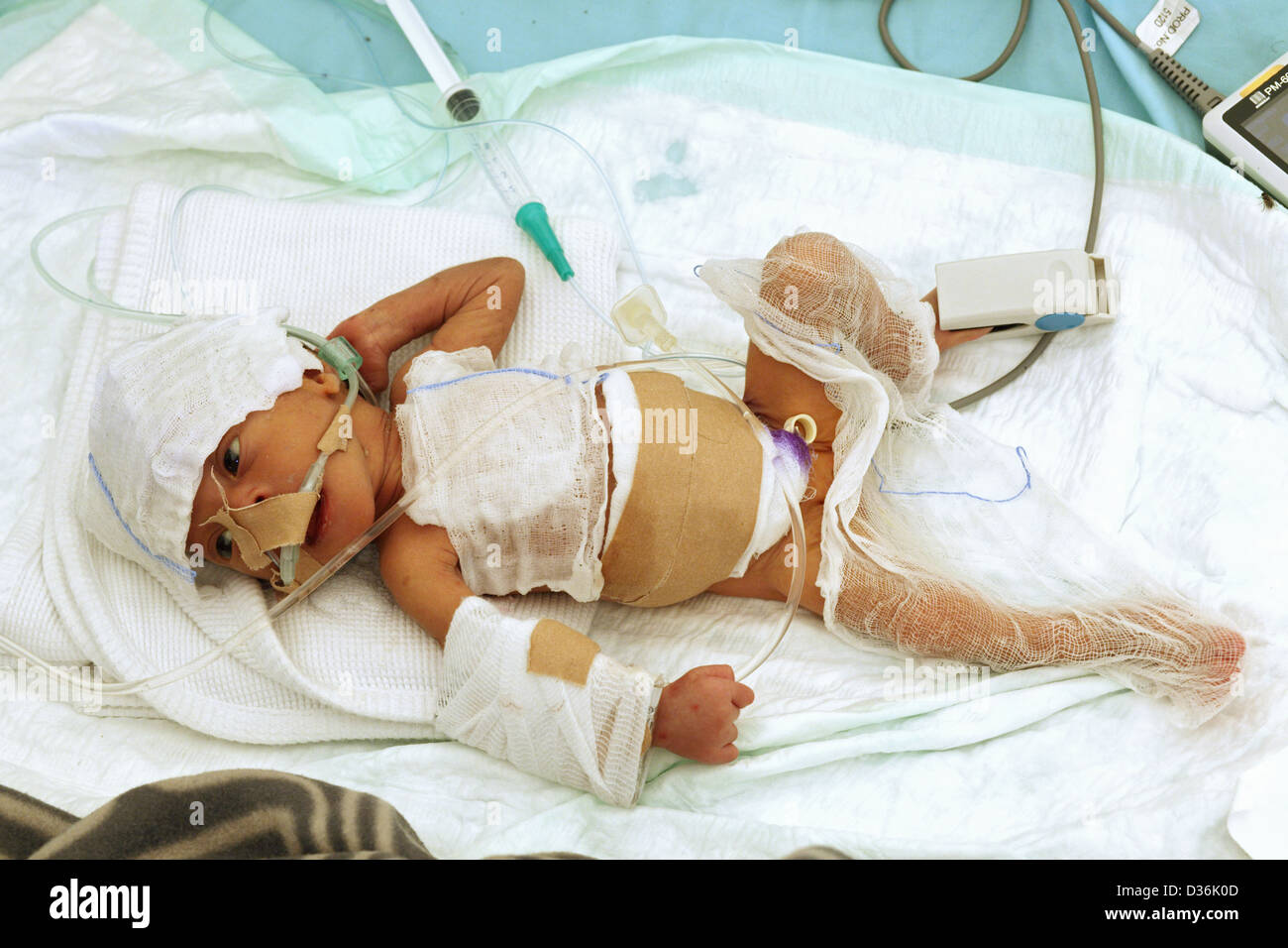 Carrefour, Haiti, sick infant in the intensive care unit of the Field Hospital Stock Photo