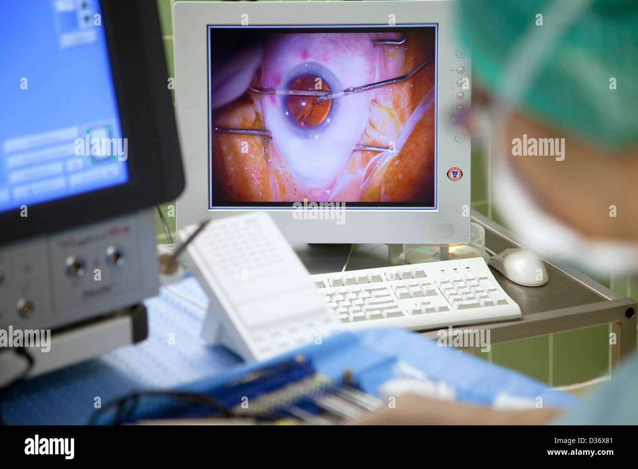Germany, Hospital, cataract surgery Stock Photo Alamy