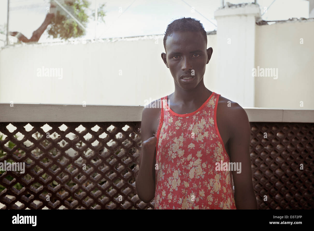 A teenager who had his hand amputated by Al-Shabaab in the turmoil of civil war in Mogadishu, Somalia Stock Photo