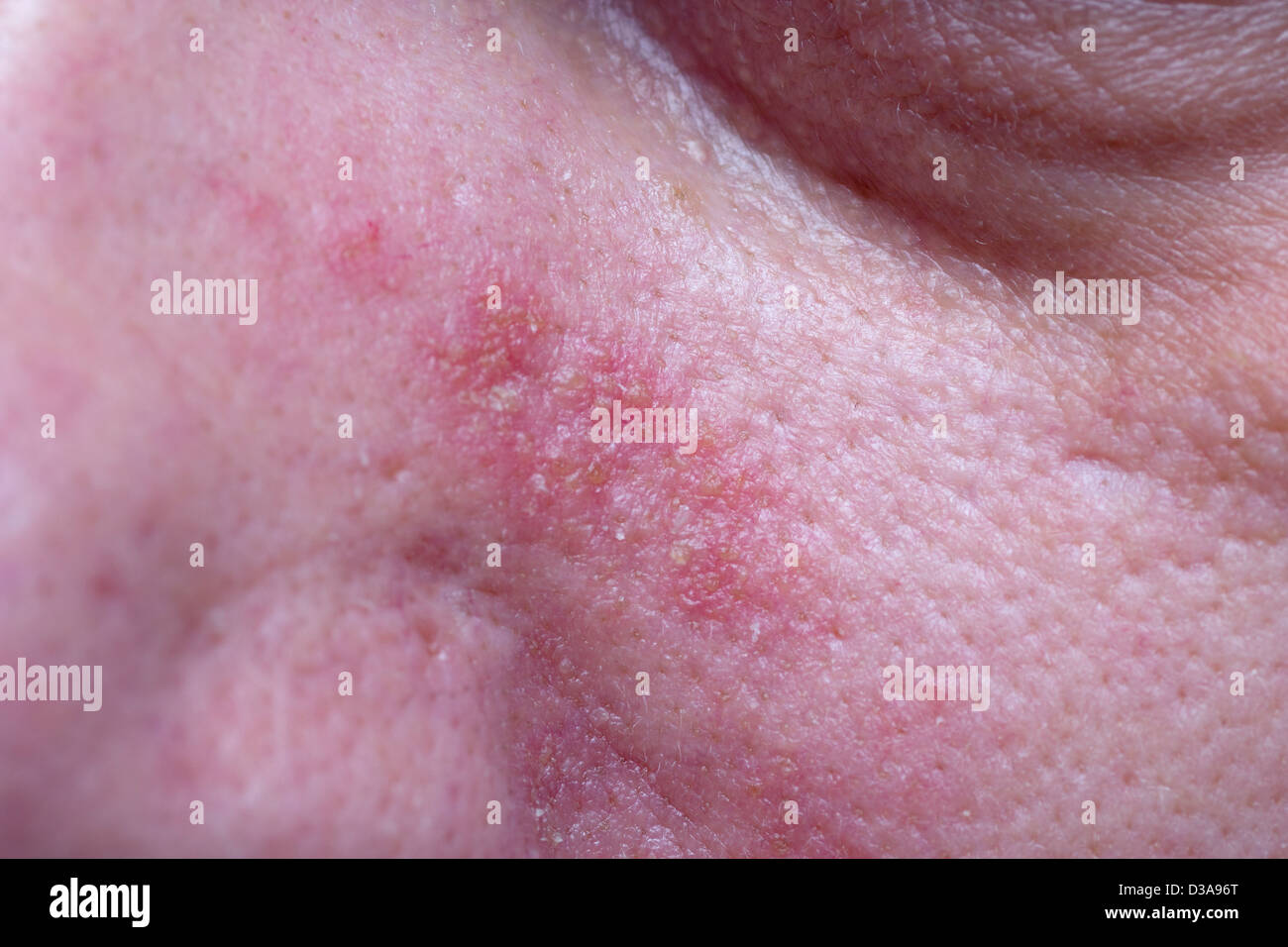 Seborrhoeic dermatitis on the face of a male (40s) Stock Photo