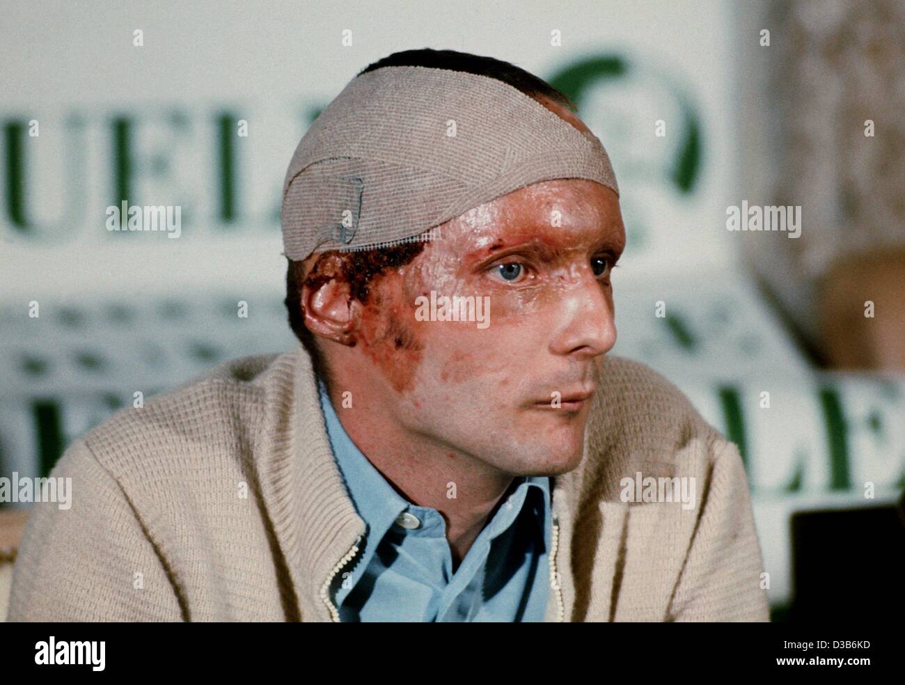 Niki Lauda Verbrennung Niki Lauda Verbrennung