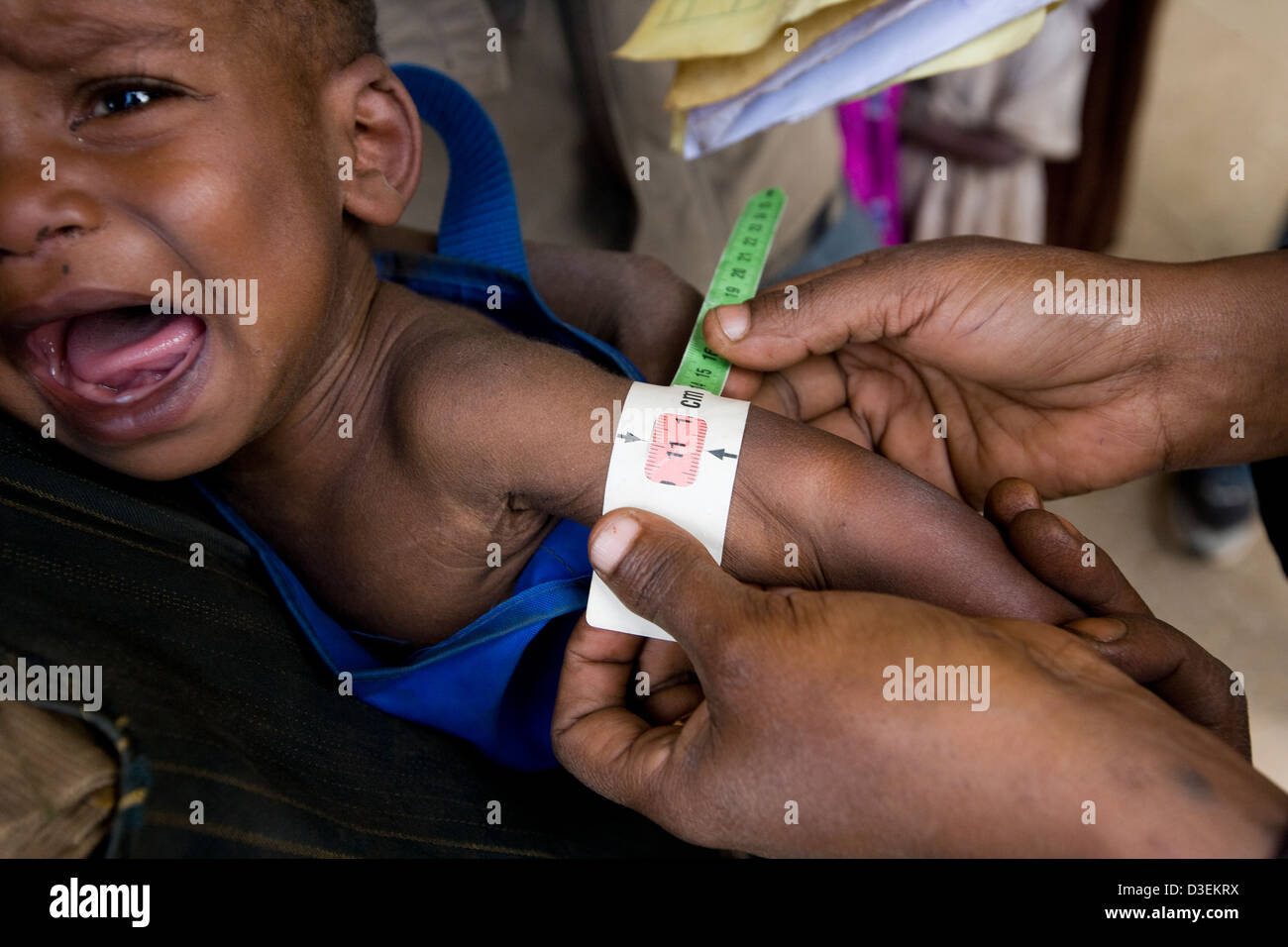 Malnourished child measuring arm hi-res stock photography and images - Alamy