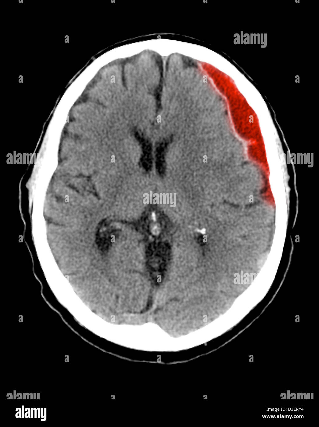 CT scan showing a subdural hematoma Stock Photo