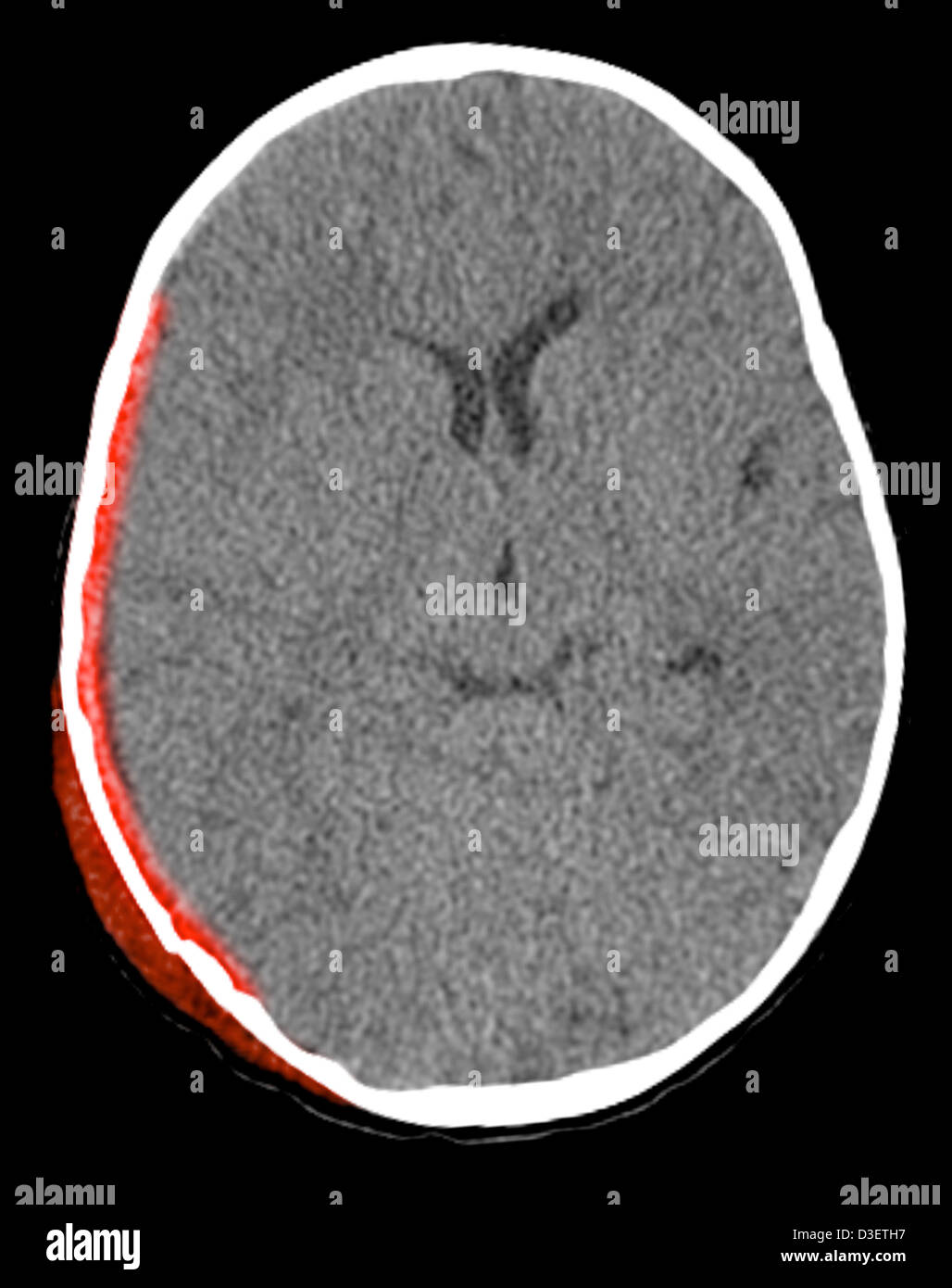 CT scan showing scalp hematoma, subdural hematoma and skull fracture in a 20 month old child Stock Photo