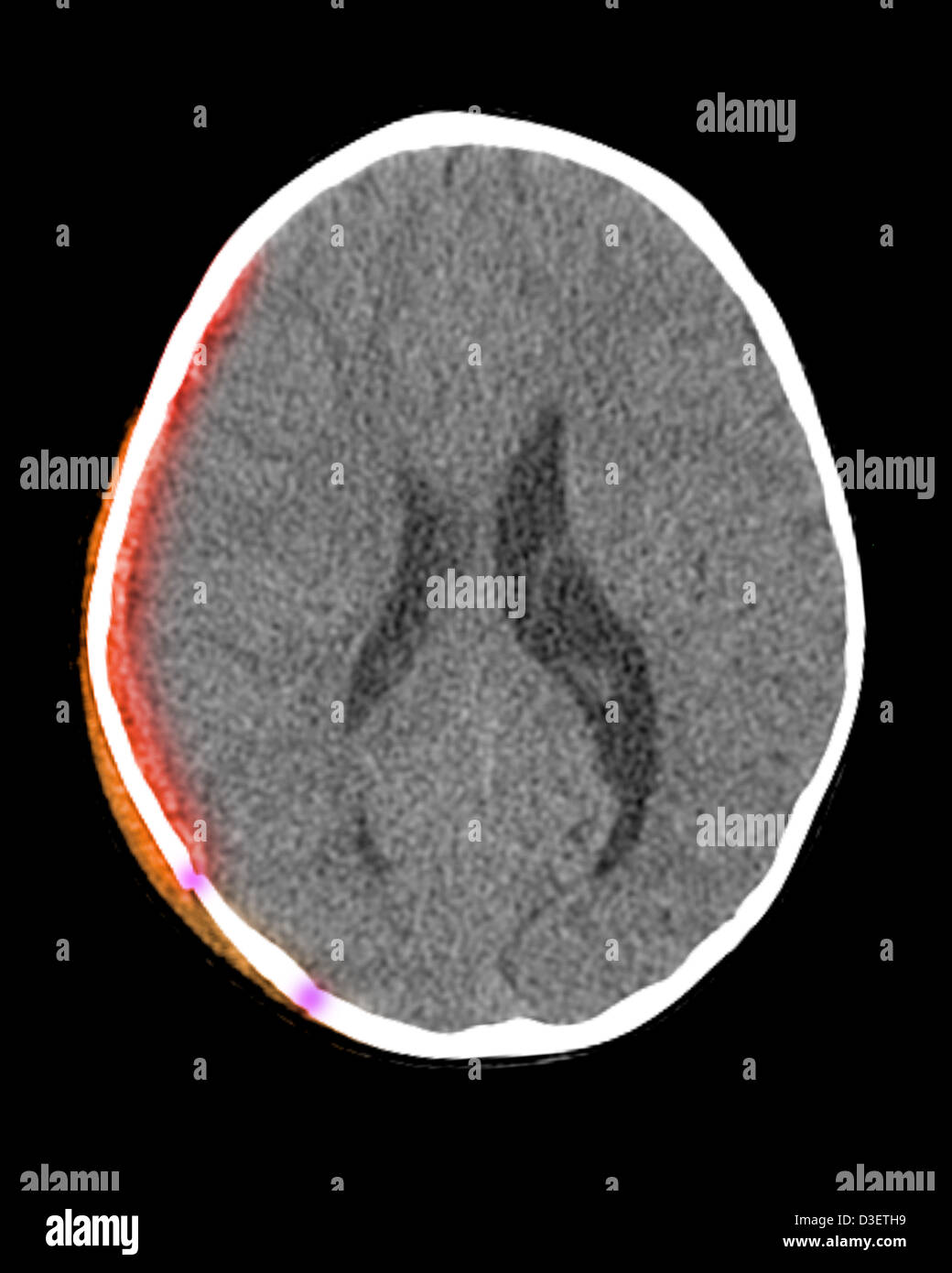 CT scan showing scalp hematoma, subdural hematoma and skull fracture in a 20 month old child Stock Photo