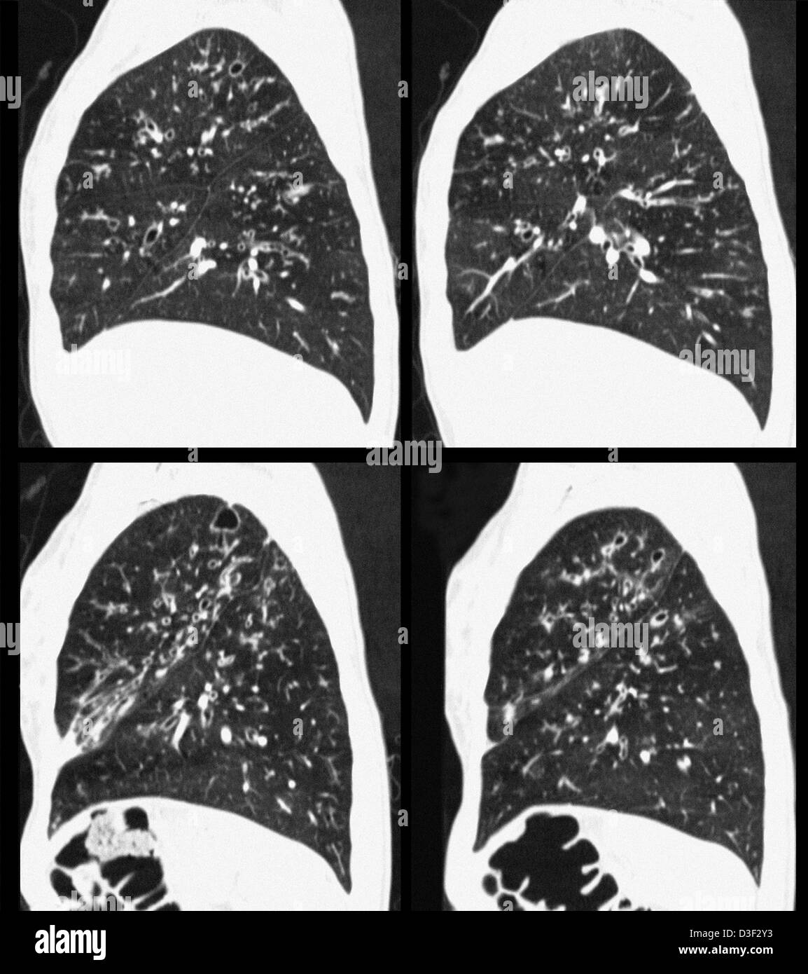 CT scan showing cystic fibrosis of the lungs Stock Photo