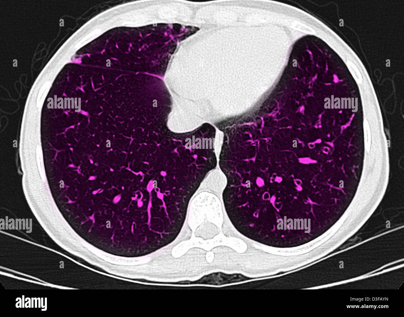 Axial slice from a high resolution CT scan of the chest of a 25 year old woman with cystic fibrosis. Stock Photo