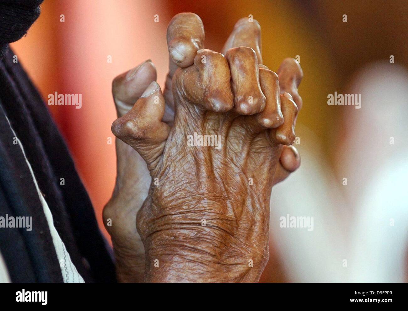 (dpa) - The hands of 70-year-old Nazir Alam who is marked with Lepra, photographed at the Lepra center in Jaipur, India, 2 March 2003. Nazir Alam has established the centre with German aid. Stock Photo