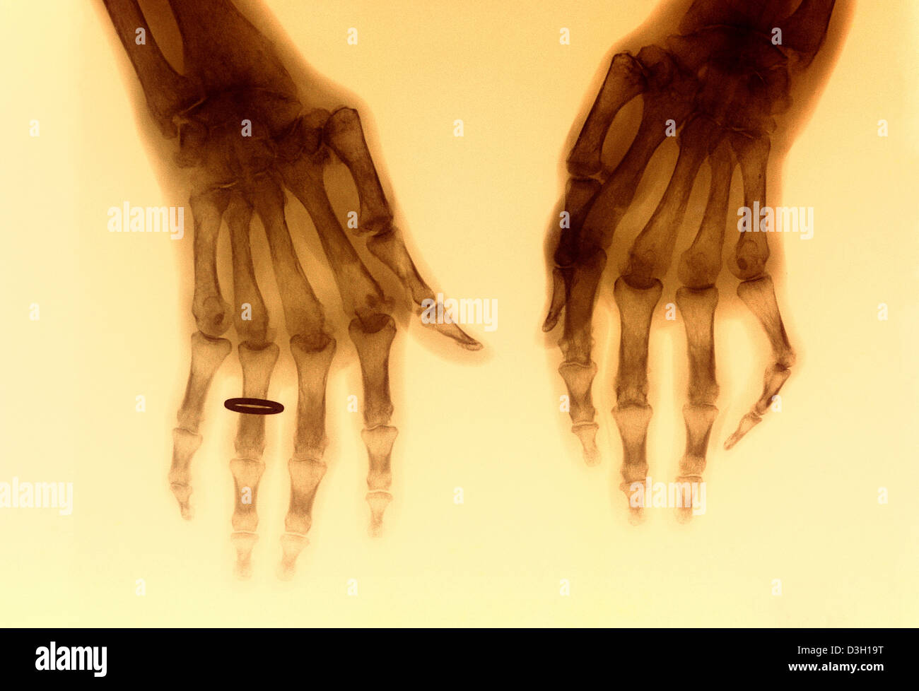 RHEUMATOID ARTHRITIS, X-RAY Stock Photo
