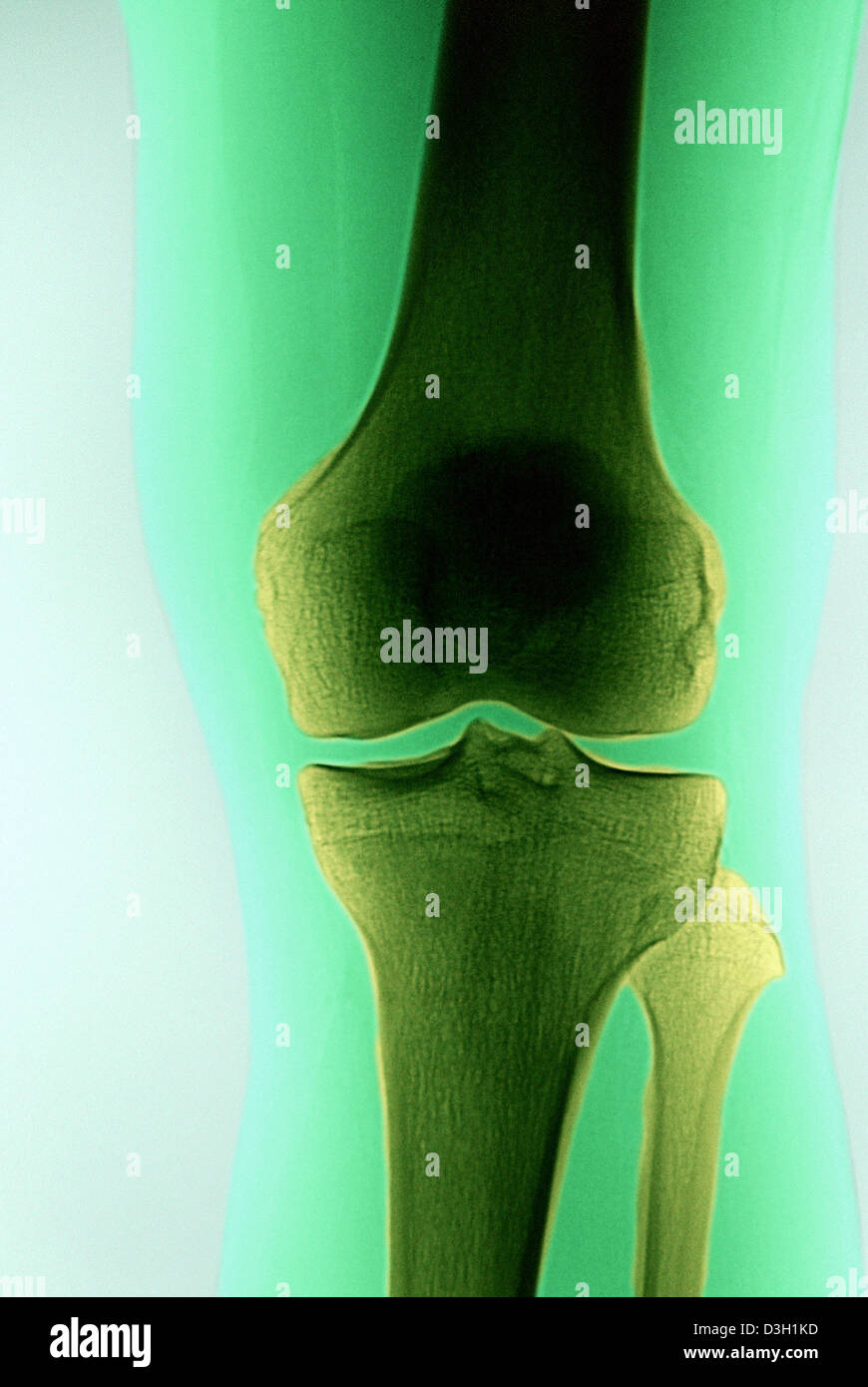 KNEE, X-RAY Stock Photo