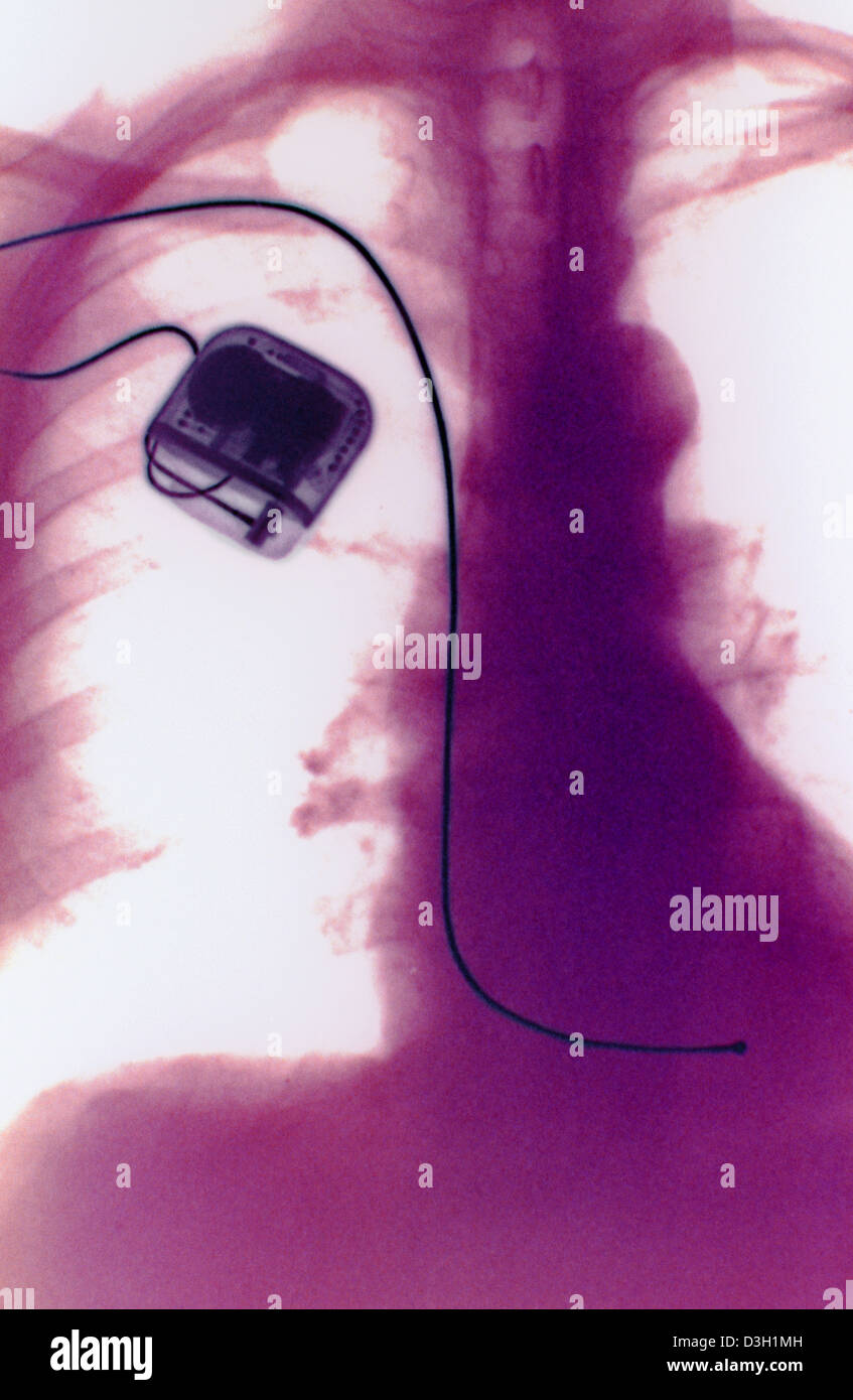Pacemaker x ray hi-res stock photography and images - Alamy