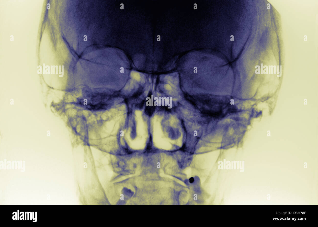 SINUS, XRAY Stock Photo Alamy