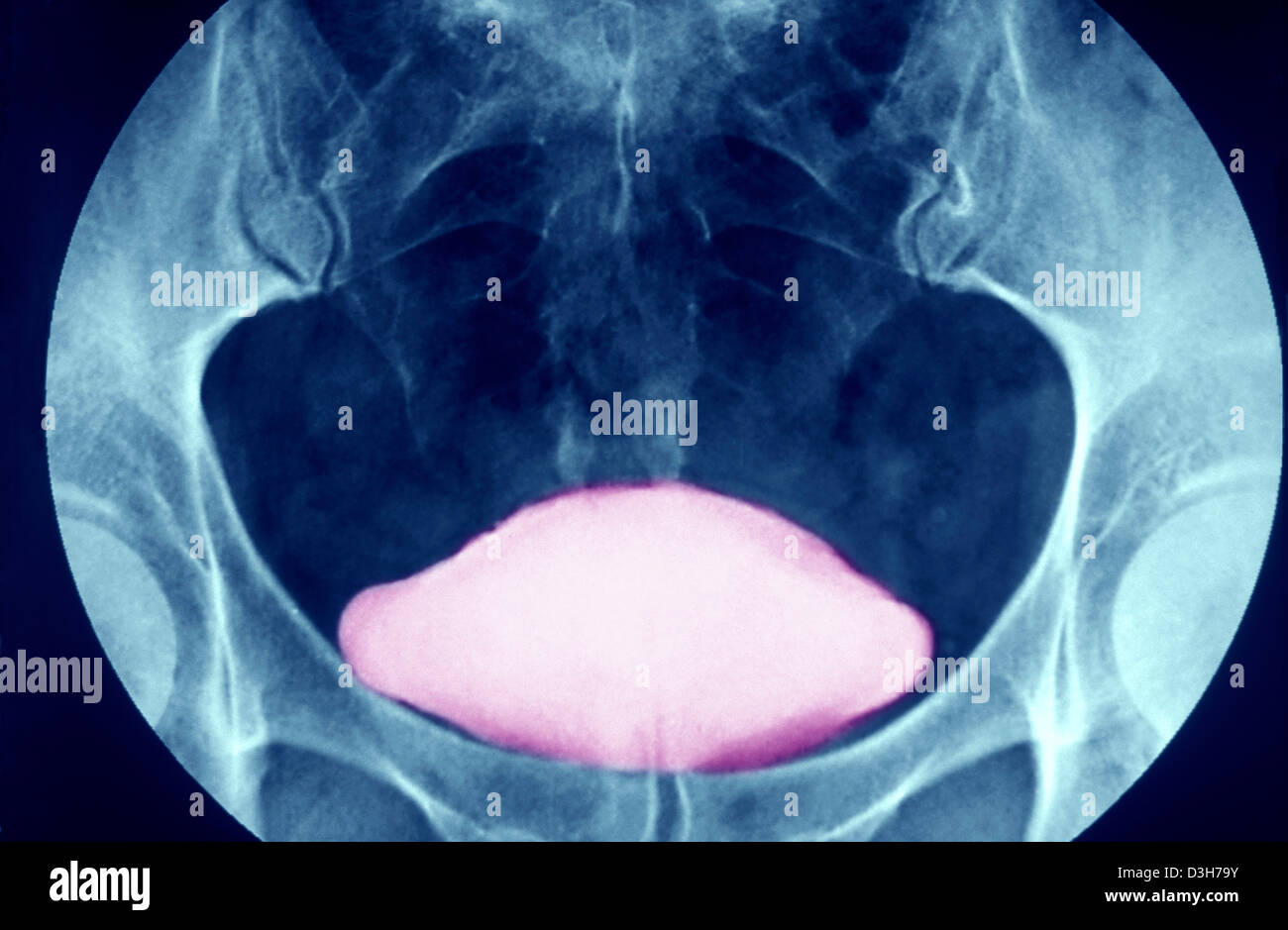 BLADDER, XRAY RESULT Stock Photo Alamy