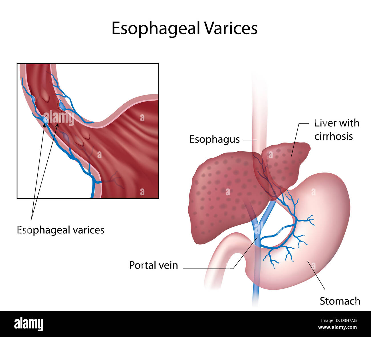 Esophageal varices due to liver cirrhosis Stock Photo
