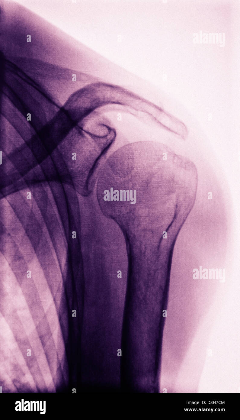Normal shoulder x ray hires stock photography and images Alamy
