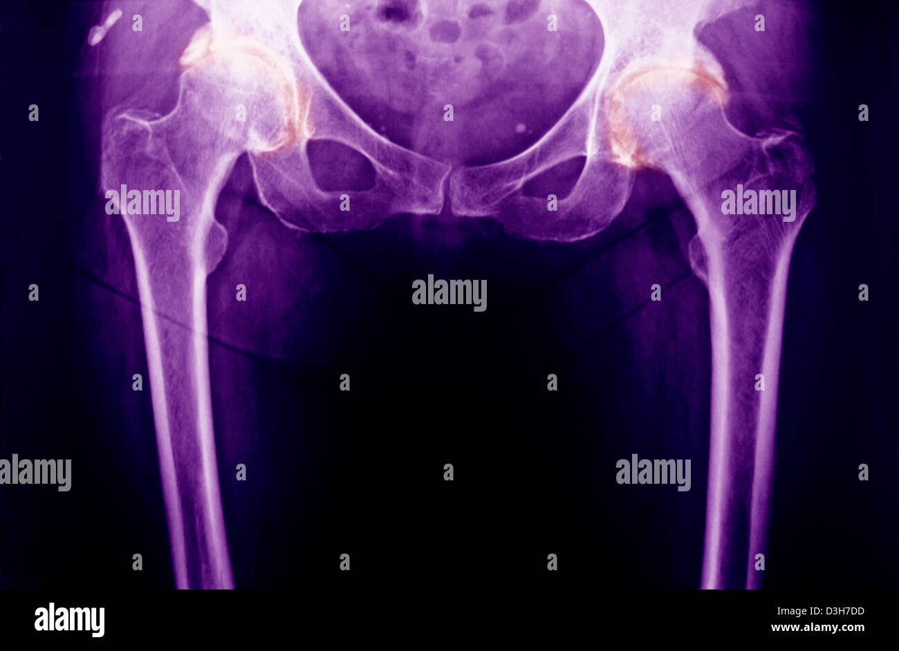 Hip Osteoarthritis X Ray High Resolution Stock Photography and Images