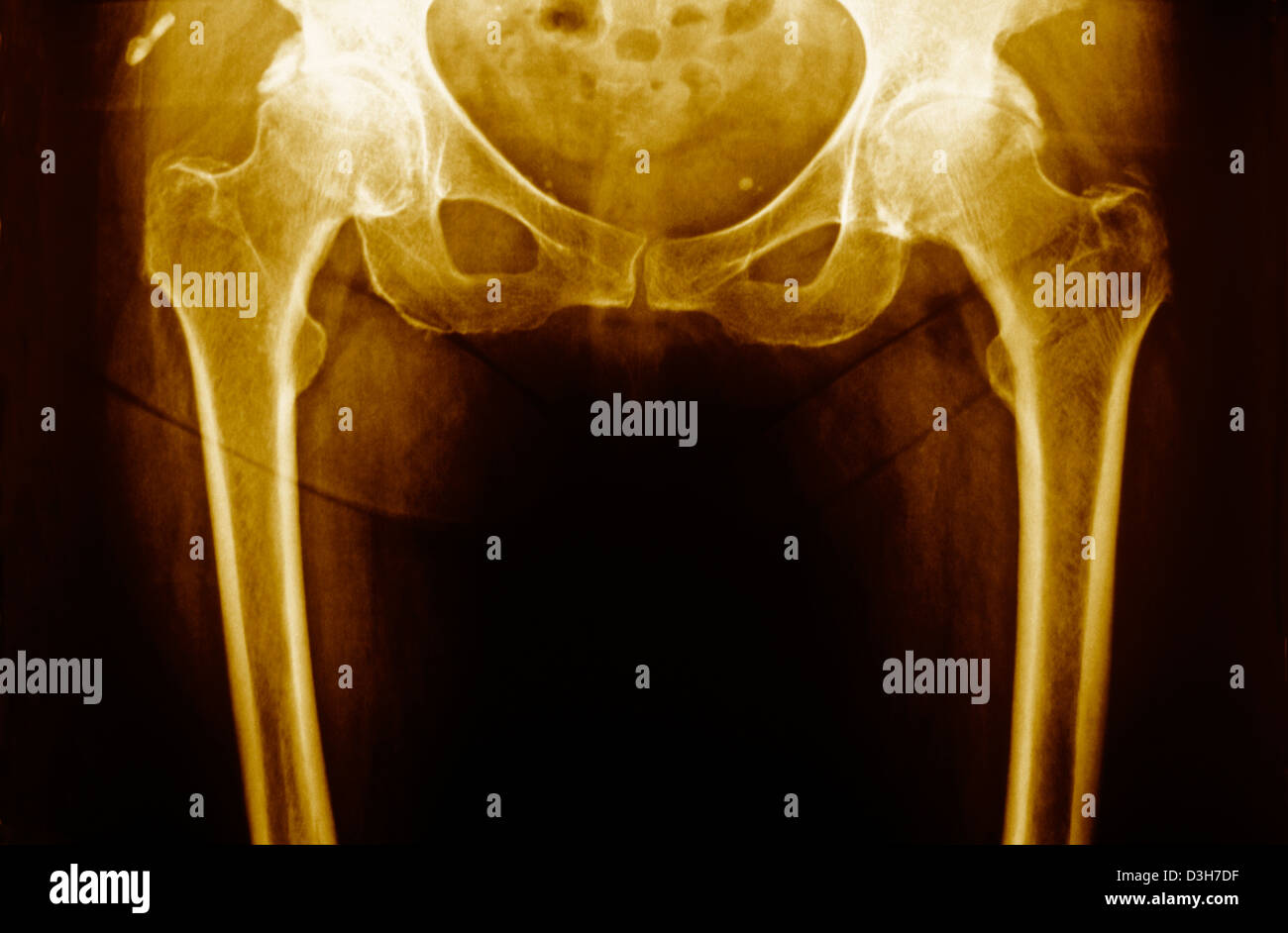 HIP OSTEOARTHRITIS, XRAY Stock Photo Alamy