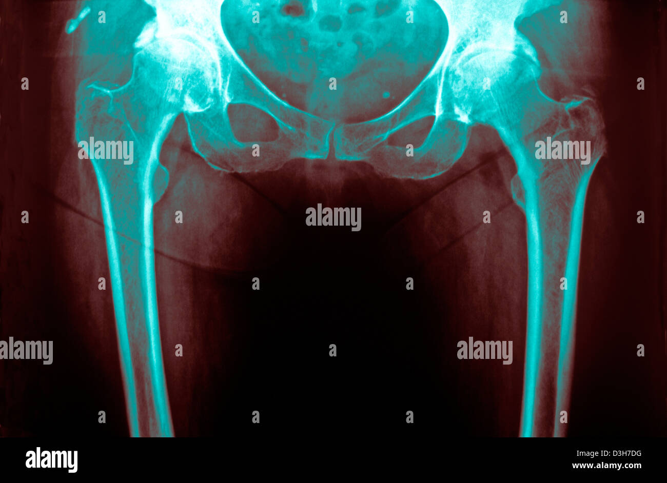 HIP OSTEOARTHRITIS, XRAY Stock Photo Alamy