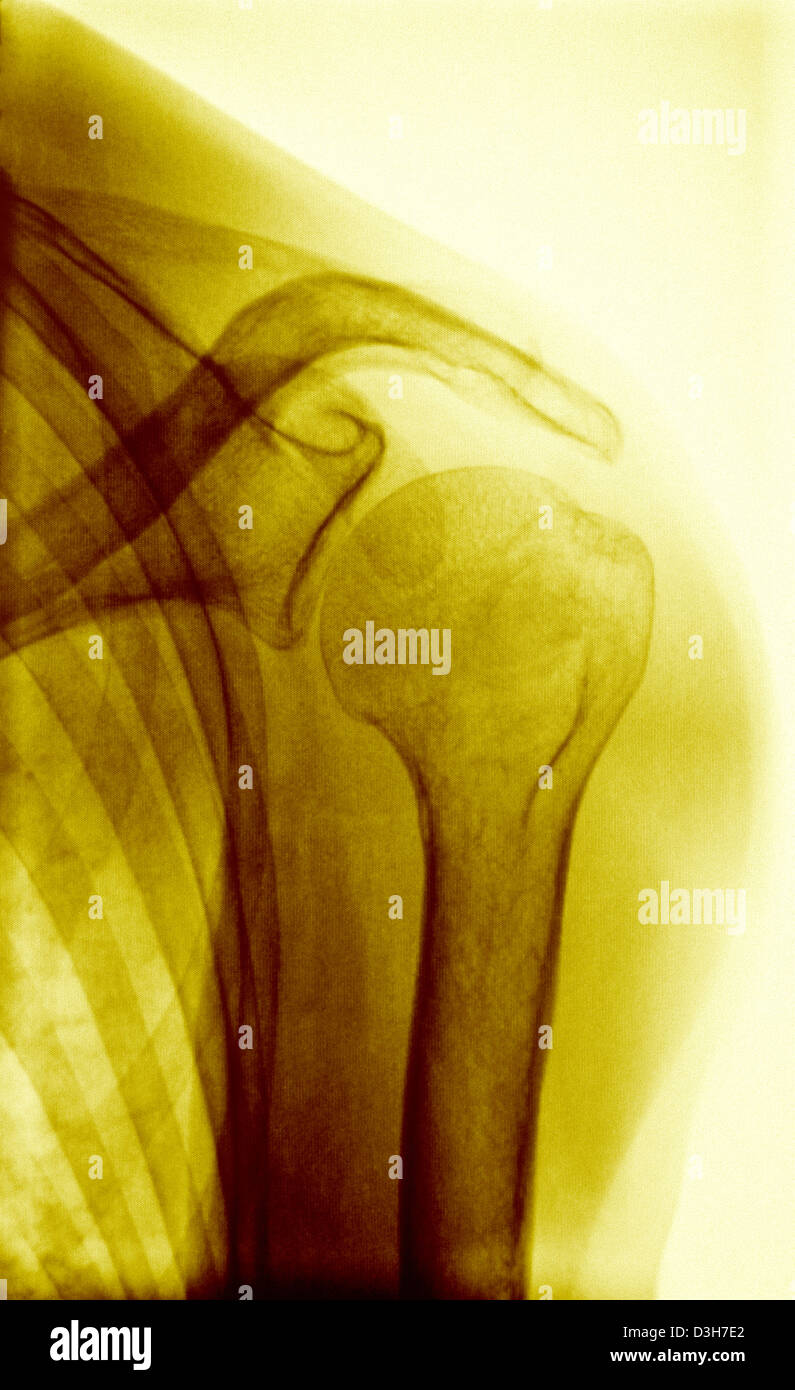 Normal shoulder x ray hires stock photography and images Alamy