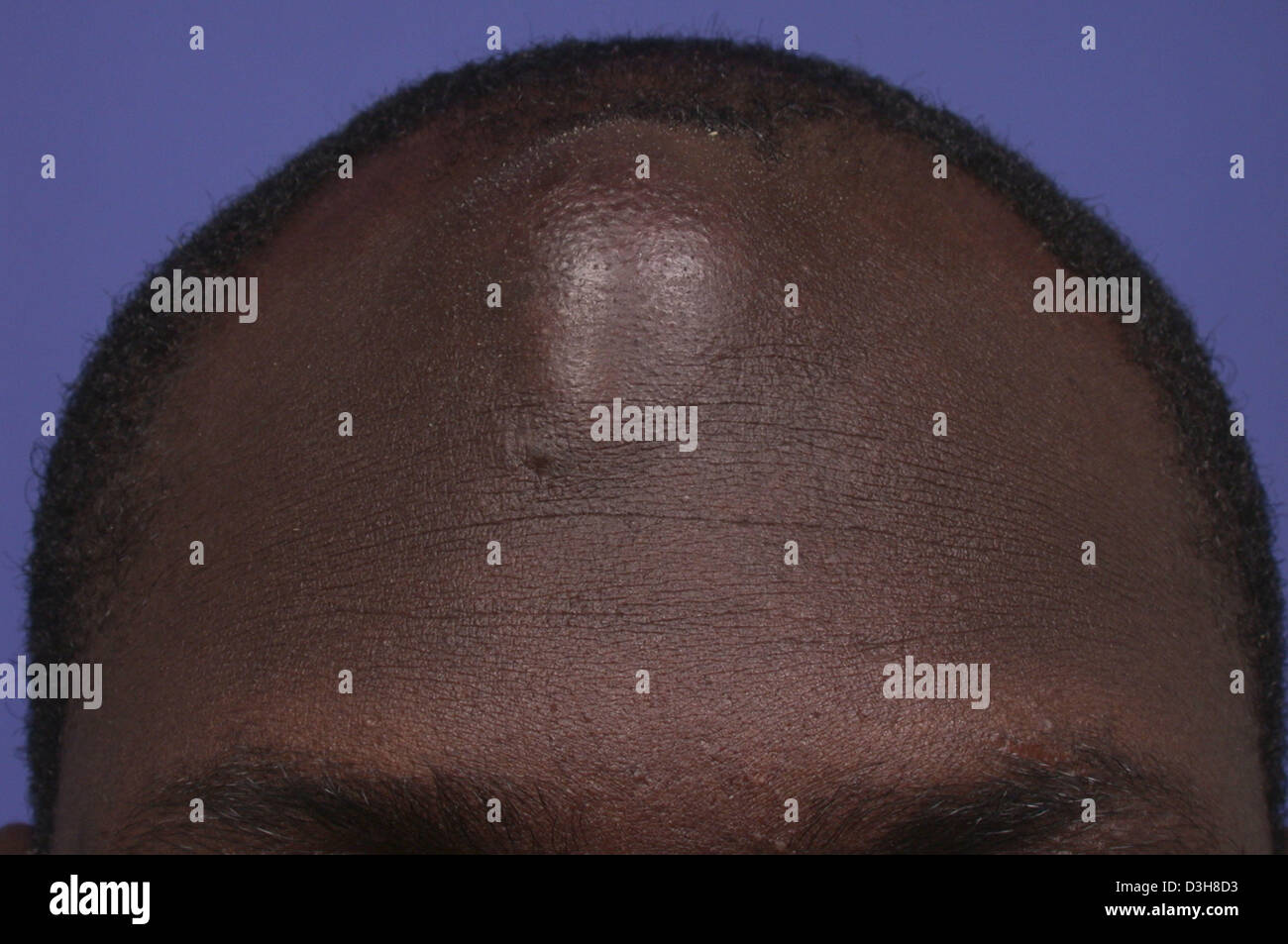 ABSCESS, FOREHEAD Stock Photo Alamy