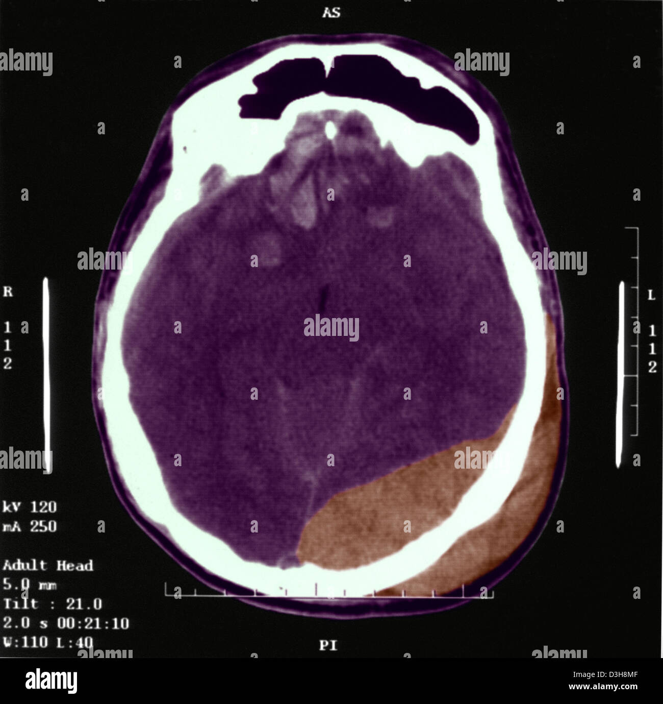 HEMATOMA, BRAIN SCAN Stock Photo