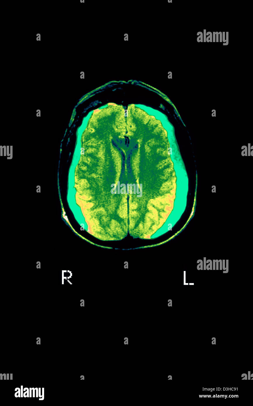 HEMATOMA, BRAIN MRI Stock Photo