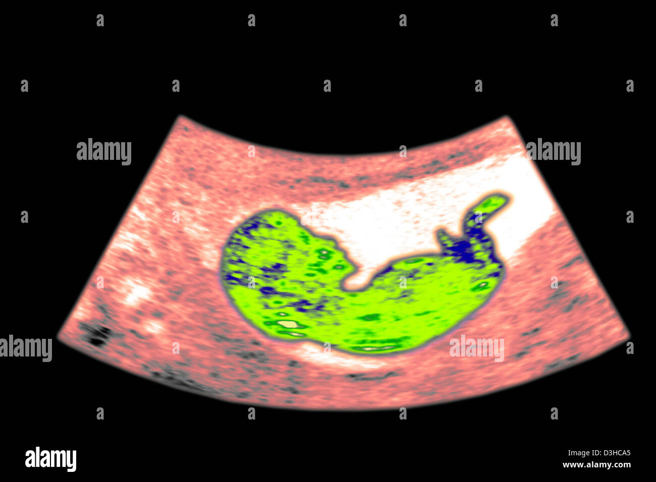 ULTRASOUND BIOMETRY OF THE FETUS Stock Photo - Alamy