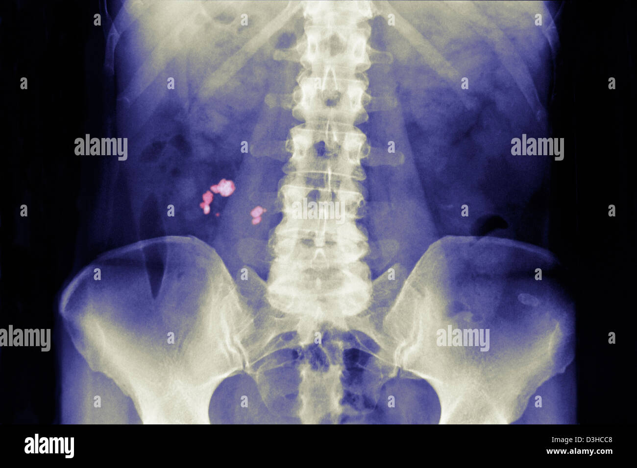 RENAL LITHIASIS, XRAY Stock Photo Alamy
