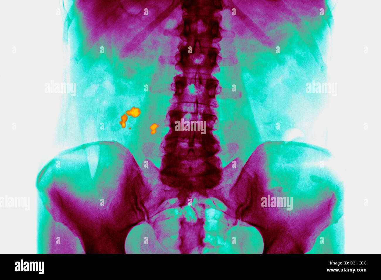 RENAL LITHIASIS, XRAY Stock Photo Alamy
