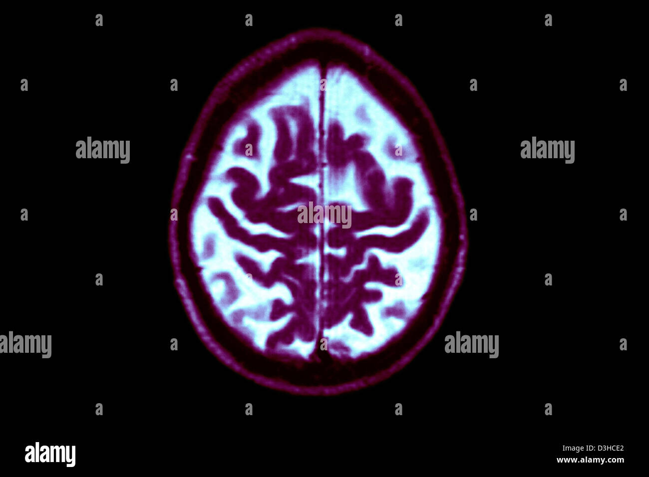 ALZHEIMER DISEASE, MRI Stock Photo - Alamy