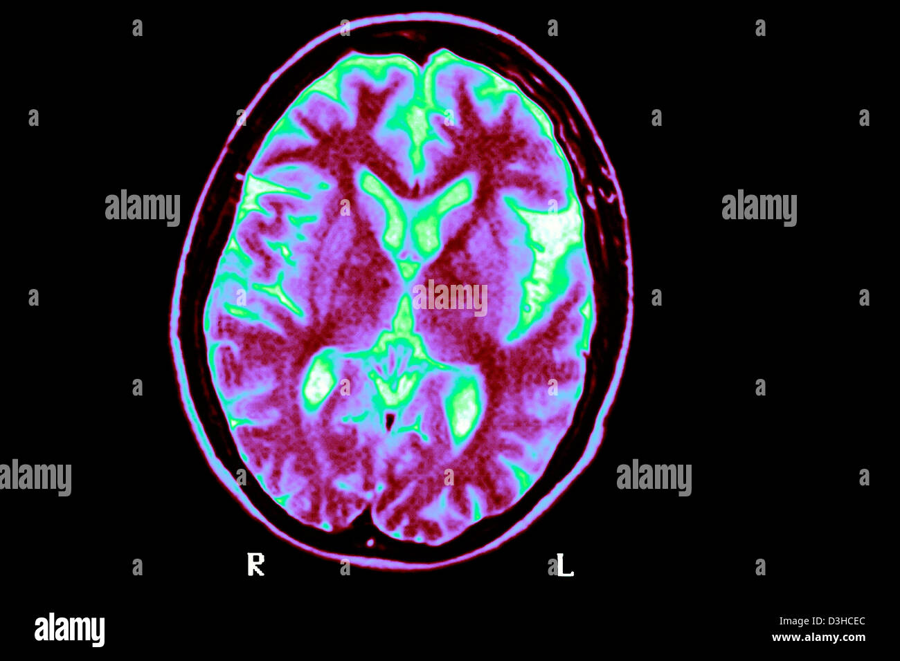 ALZHEIMER DISEASE, MRI Stock Photo - Alamy