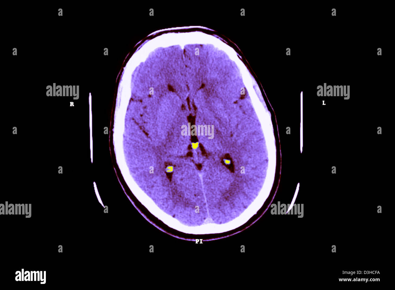 CREUTZFELDT JAKOB DISEASE, MRI Stock Photo Alamy