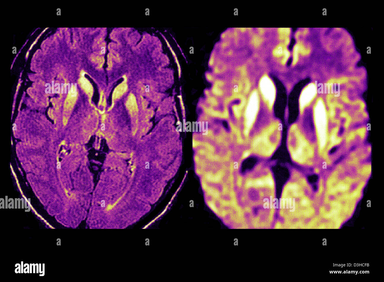 Brain mad cow disease hires stock photography and images Alamy
