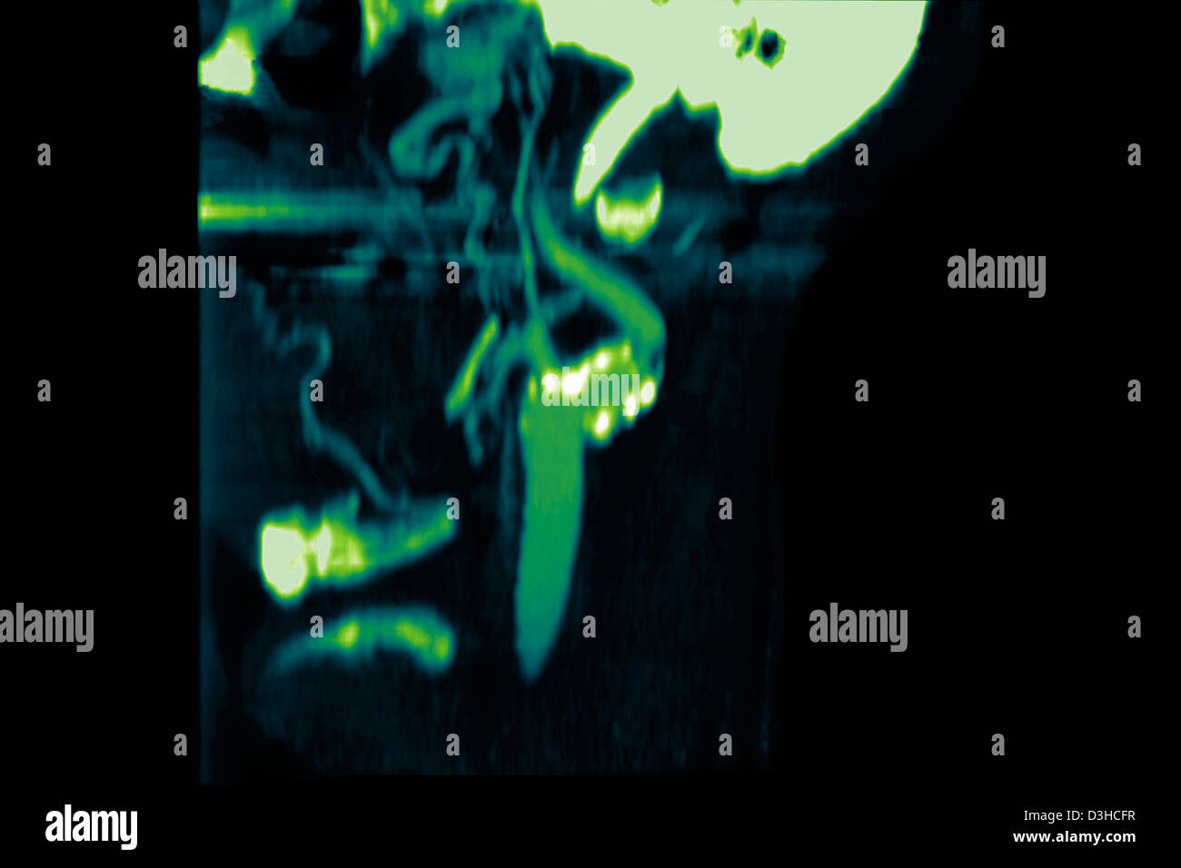 Blood vessel calcification hi-res stock photography and images - Alamy