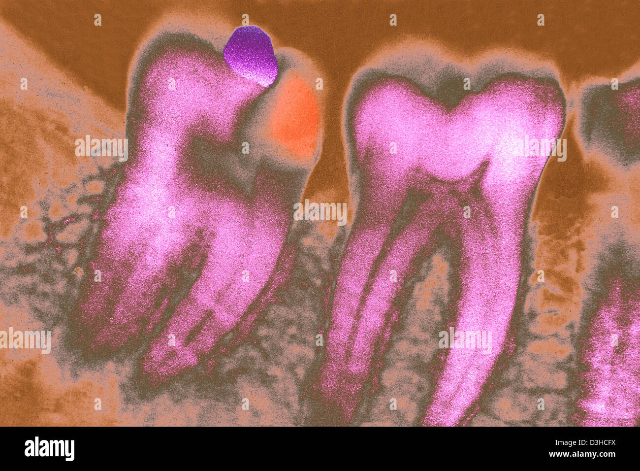 TOOTH DECAY, XRAY Stock Photo Alamy
