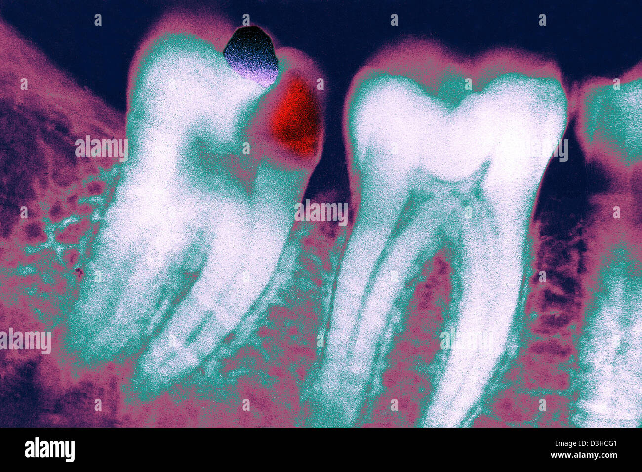 TOOTH DECAY, XRAY Stock Photo Alamy