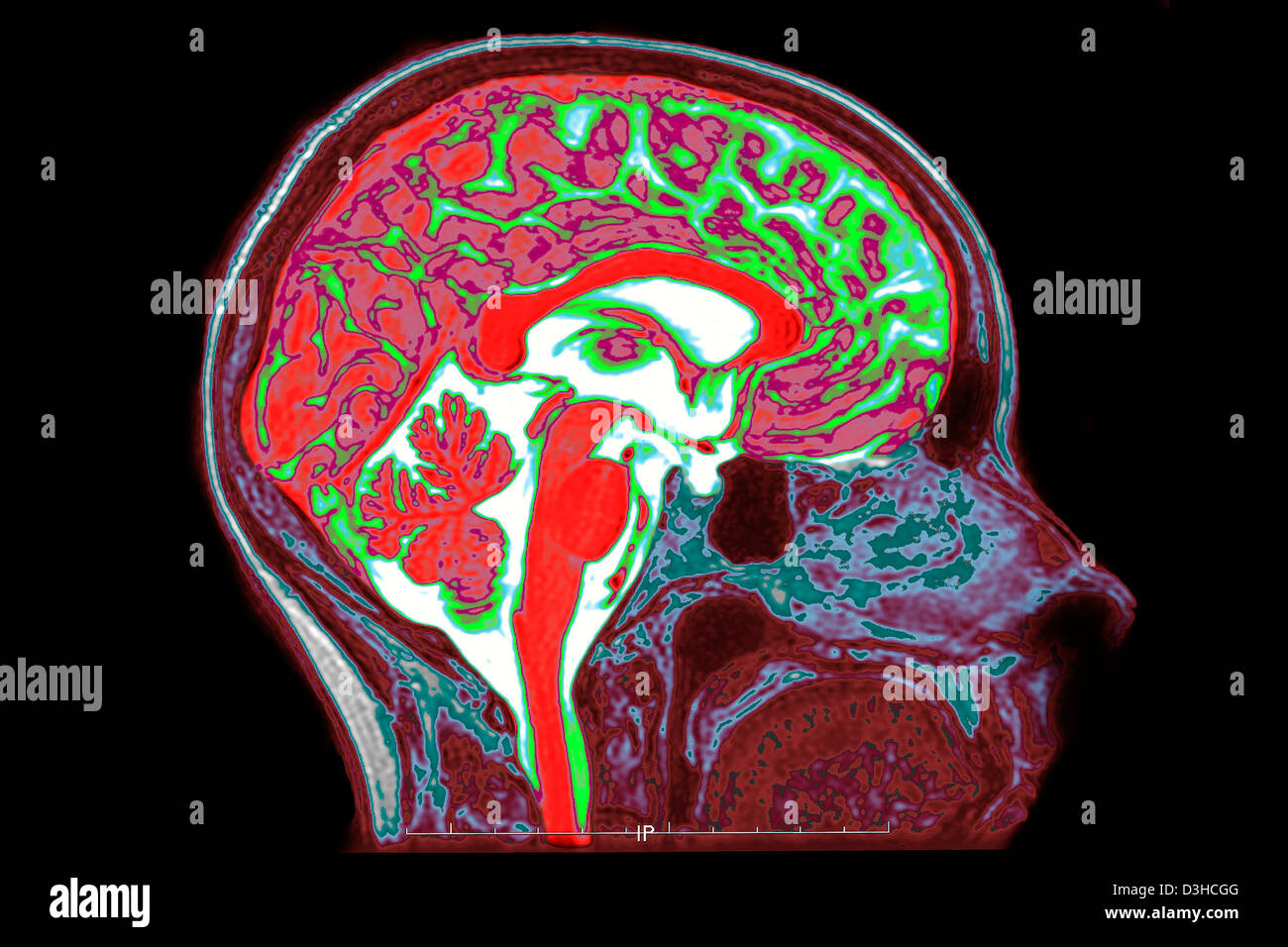 Mri Brain Scan Normal High Resolution Stock Photography and Images - Alamy