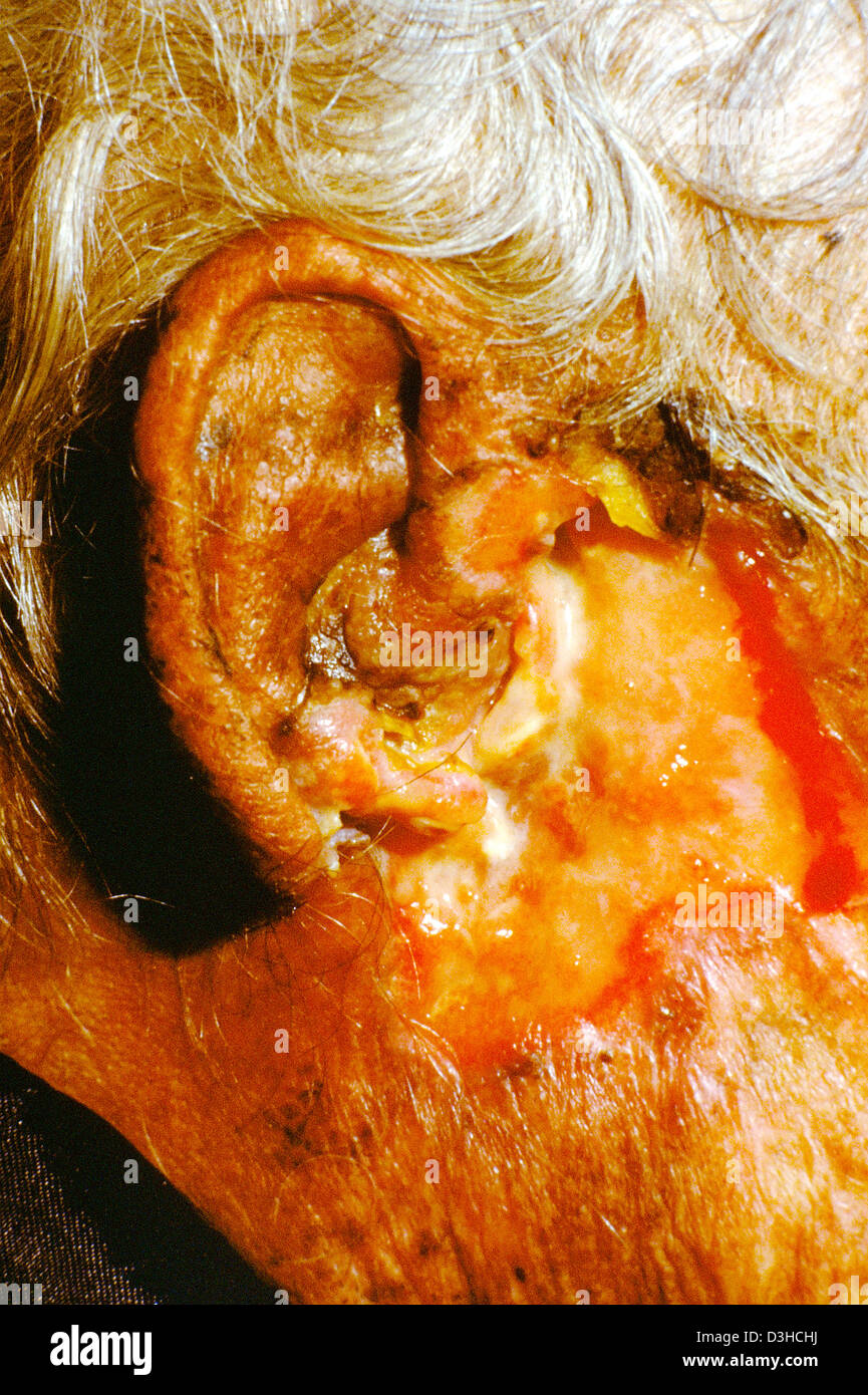 SQUAMOUS CELL CARCINOMA Stock Photo
