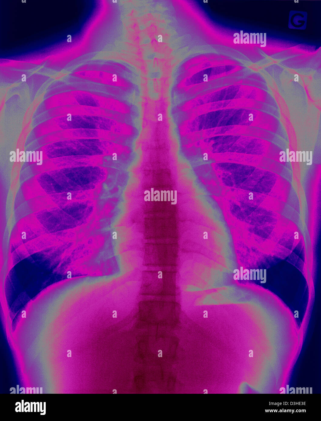 LUNG, XRAY RESULT Stock Photo Alamy