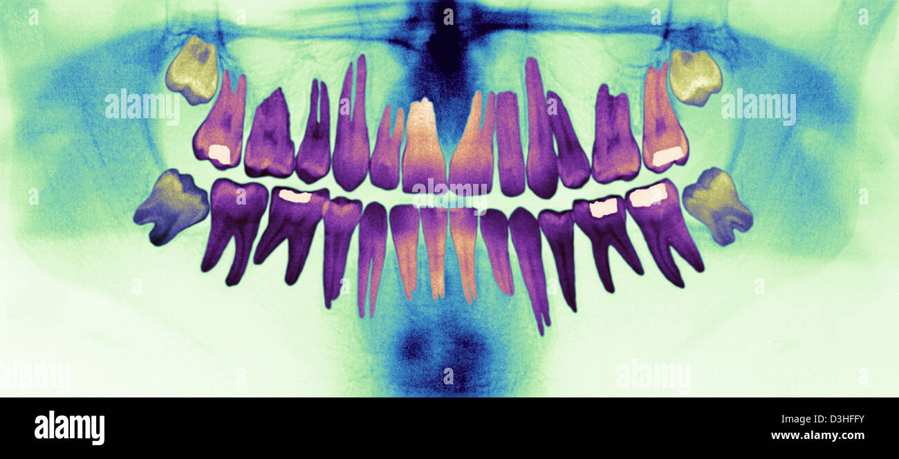 DENTAL XRAY RESULT Stock Photo Alamy