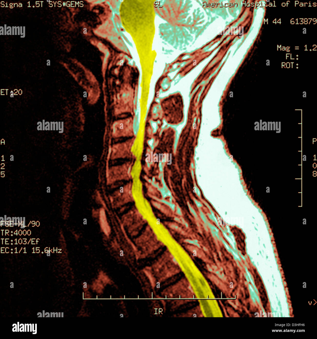 Cervical spine mri hi-res stock photography and images - Alamy