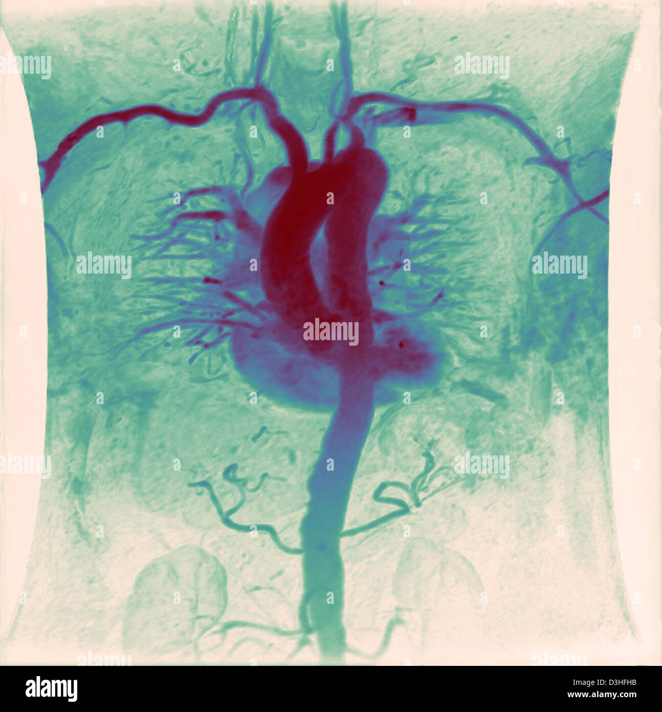 HEART, ANGIOGRAPHY Stock Photo