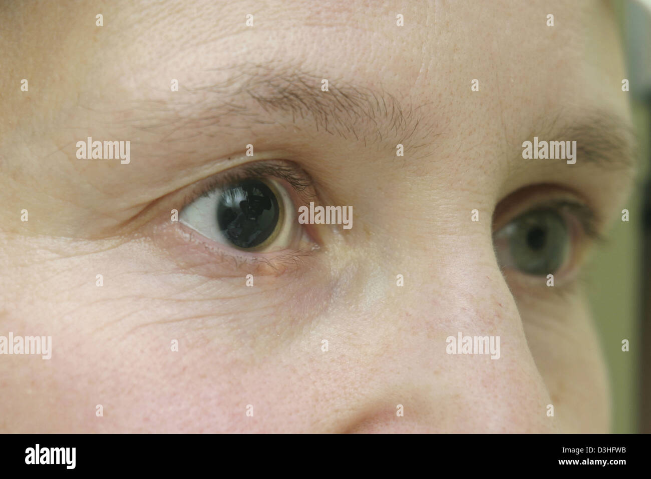 MYDRIASIS Stock Photo - Alamy