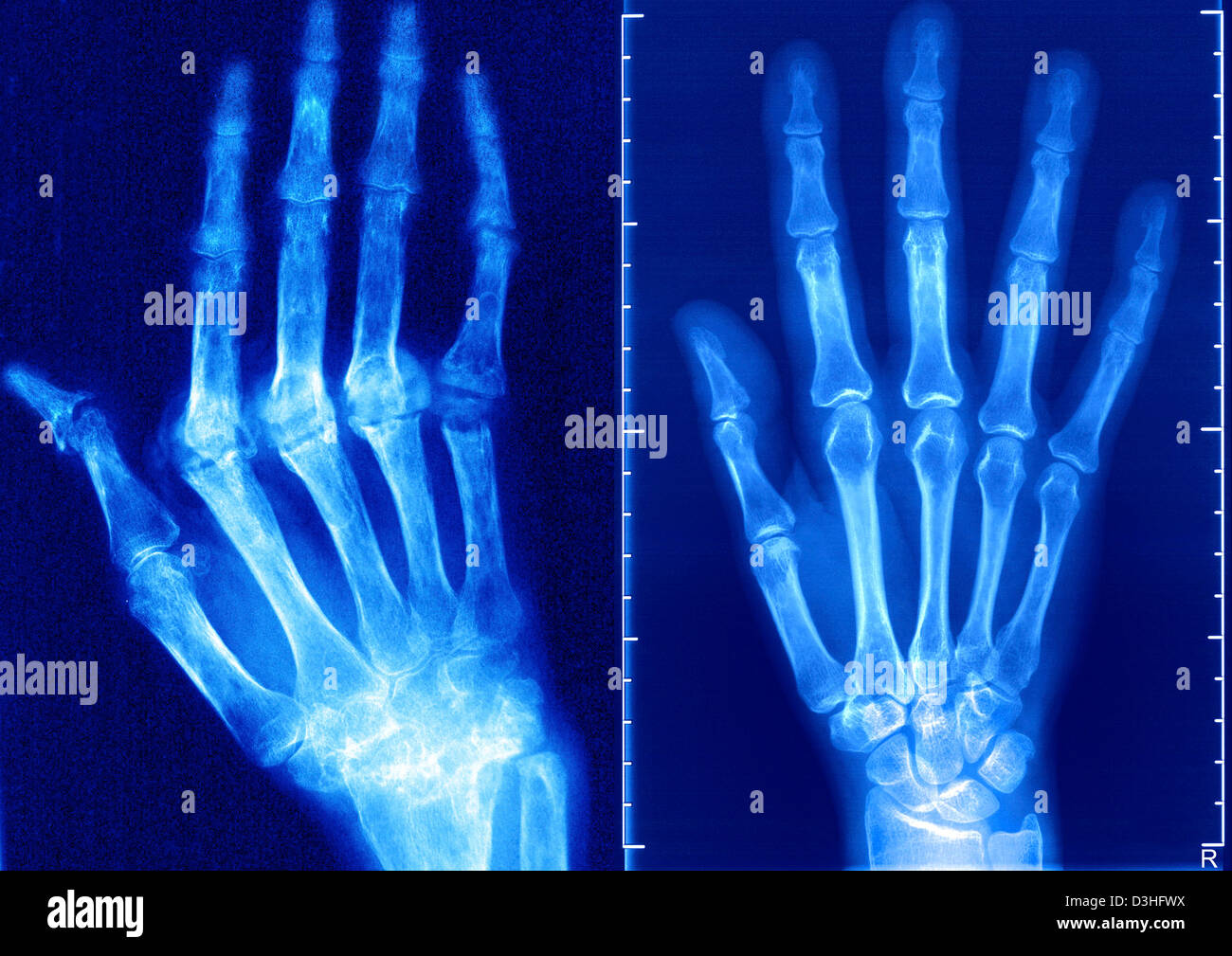 Rheumatoid arthritis hands x ray hires stock photography and images