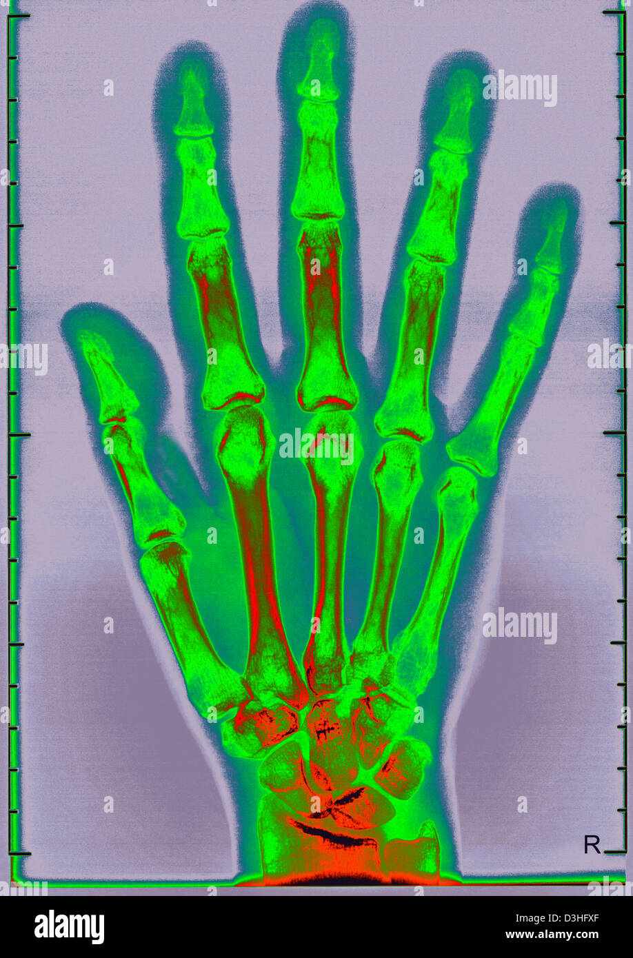 X ray normal hand hires stock photography and images Alamy