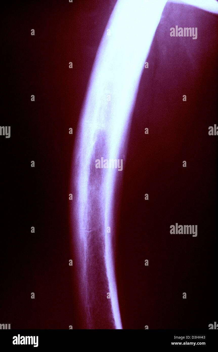 PAGET'S DISEASE, XRAY Stock Photo Alamy