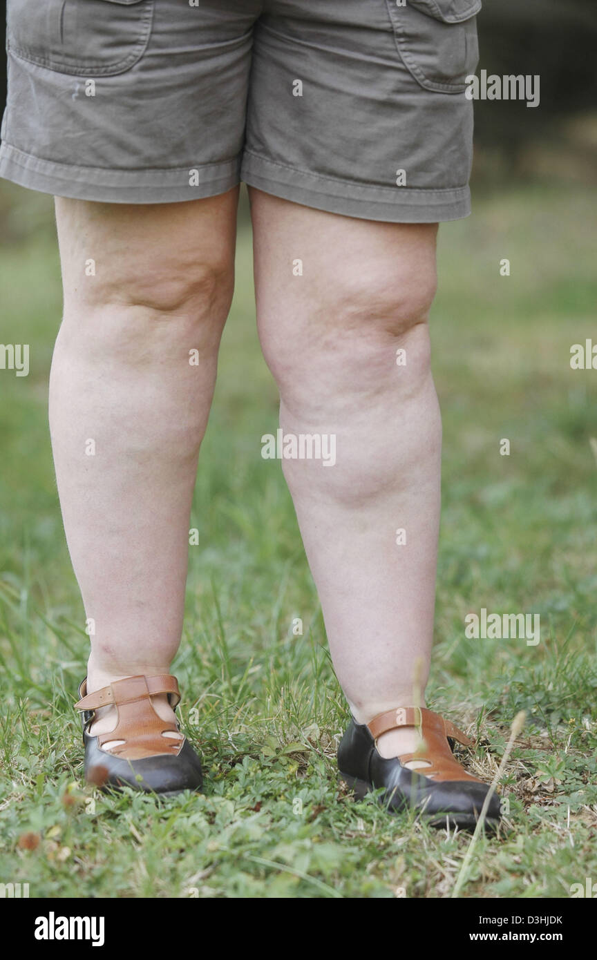 RHEUMATOID ARTHRITIS CLINICAL P Stock Photo Alamy