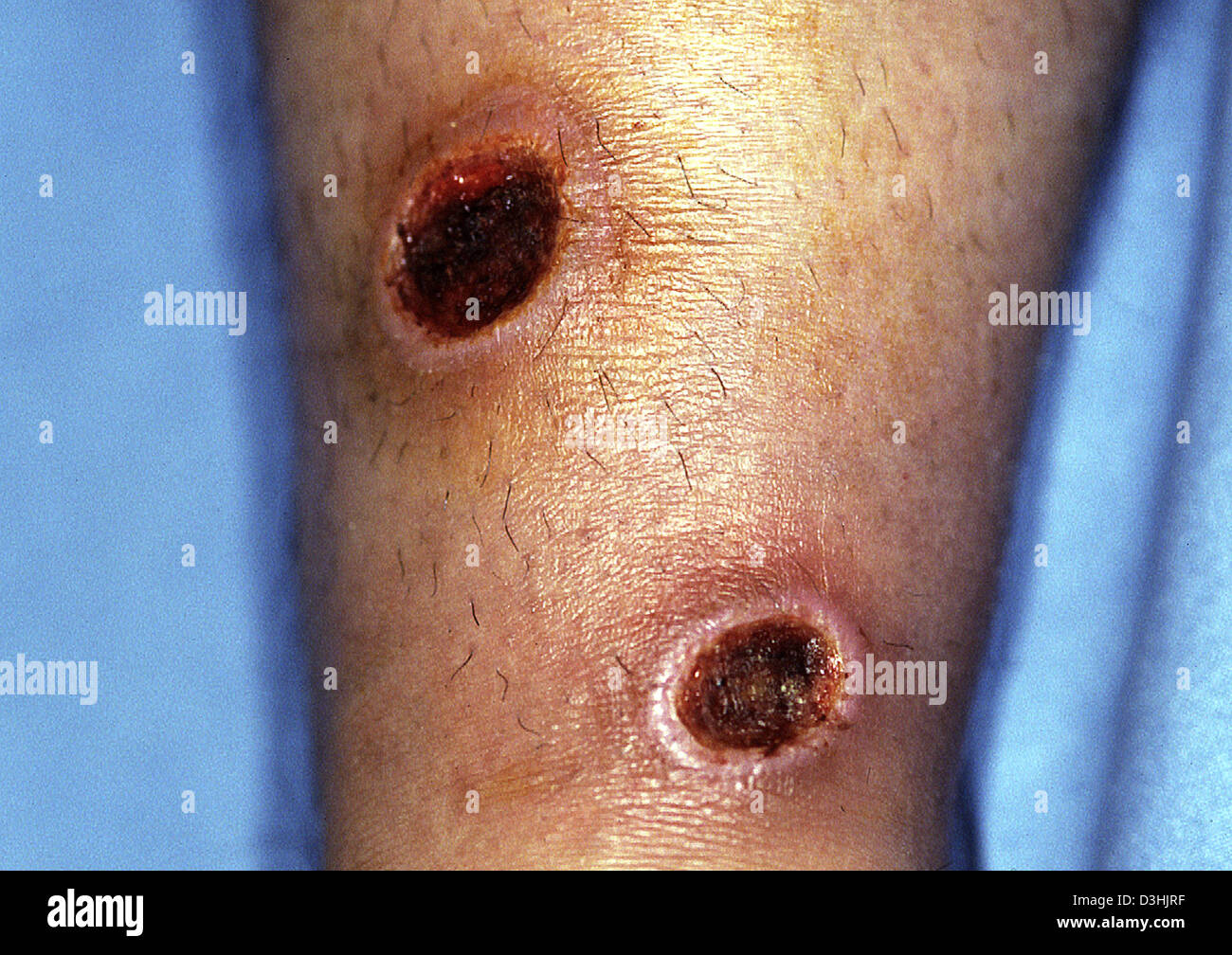 leishmaniasis cutanea