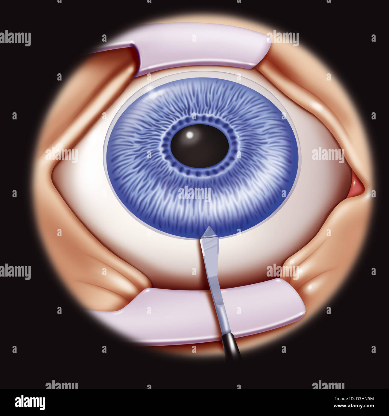 Anterior chamber intraocular lenses hires stock photography and images